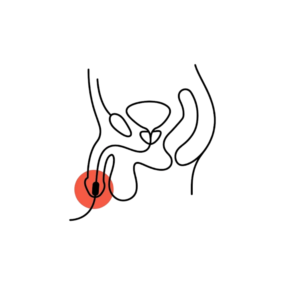 Colocación de sonda